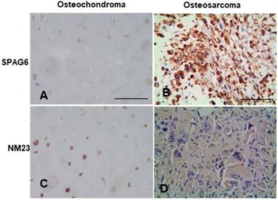 Aberrant expression of SPAG6 and NM23 predicts poor prognosis of human osteosarcoma